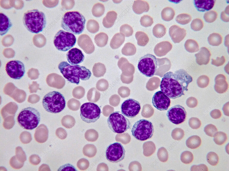 LEUCEMIA LINFOCÍTICA CRÓNICA - EduLabC